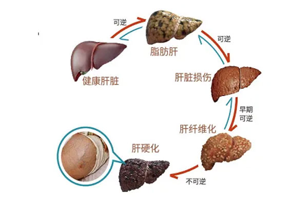 脂肪肝可以“吃”回去？